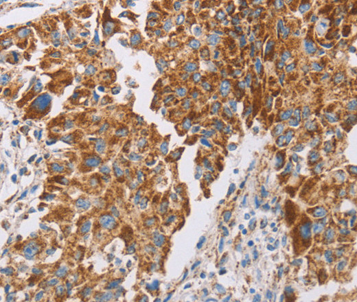 Immunohistochemistry of paraffin-embedded Human lung cancer tissue using GUCY1A3 Polyclonal Antibody at dilution 1:40