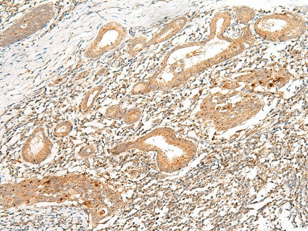 Immunohistochemistry of paraffin-embedded Human esophagus cancer tissue  using HLA-G Polyclonal Antibody at dilution of 1:45(?200)