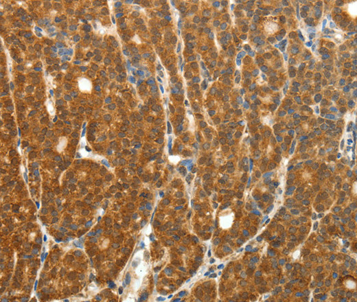 Immunohistochemistry of paraffin-embedded Human thyroid cancer using PTCH1 Polyclonal Antibody at dilution of 1:50