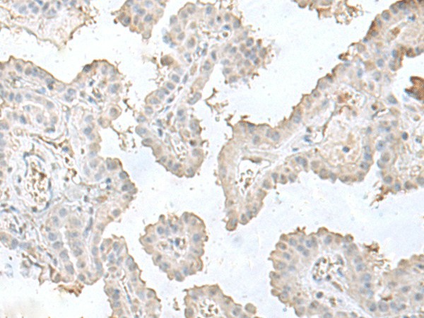 Immunohistochemistry of paraffin-embedded Human thyroid cancer tissue  using LSM10 Polyclonal Antibody at dilution of 1:50(?200)