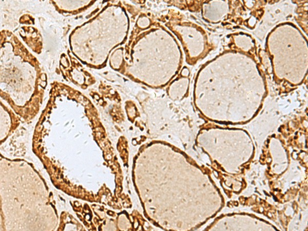 Immunohistochemistry of paraffin-embedded Human thyroid cancer tissue  using LYRM1 Polyclonal Antibody at dilution of 1:40(?200)