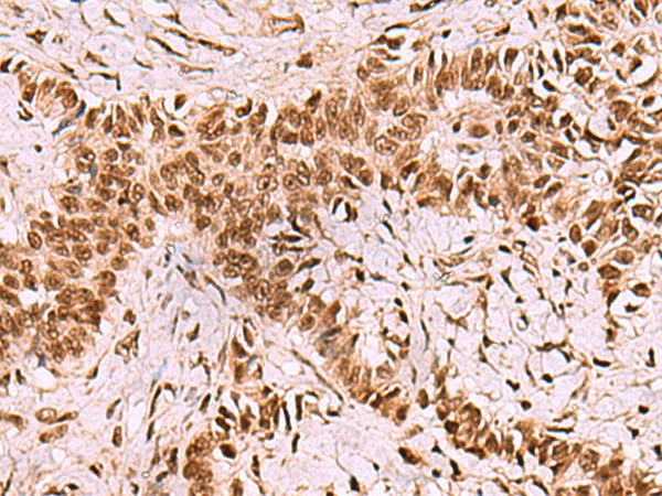 Immunohistochemistry of paraffin-embedded Human ovarian cancer tissue  using LDB1 Polyclonal Antibody at dilution of 1:70(?200)