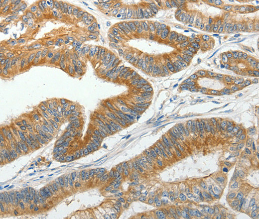 Immunohistochemistry of paraffin-embedded Human colon cancer tissue using SLC12A4 Polyclonal Antibody at dilution 1:30