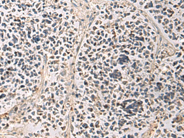 Immunohistochemistry of paraffin-embedded Human breast cancer tissue  using PAIP1 Polyclonal Antibody at dilution of 1:80(?200)