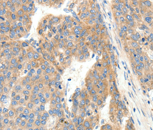 Immunohistochemistry of paraffin-embedded Human ovarian cancer tissue using COL4A1 Polyclonal Antibody at dilution 1:30