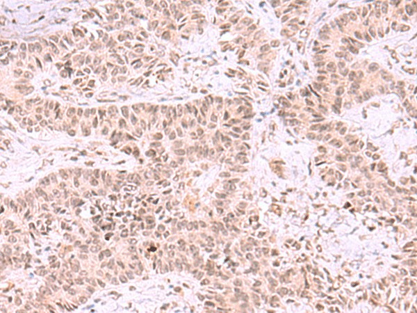 Immunohistochemistry of paraffin-embedded Human ovarian cancer tissue  using MCMBP Polyclonal Antibody at dilution of 1:35(?200)