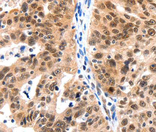 Immunohistochemistry of paraffin-embedded Human ovarian cancer tissue using LRP5 Polyclonal Antibody at dilution 1:115