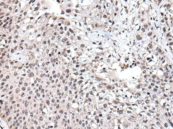 Immunohistochemistry of paraffin-embedded Human lung cancer tissue  using UBE2E3 Polyclonal Antibody at dilution of 1:40(?200)