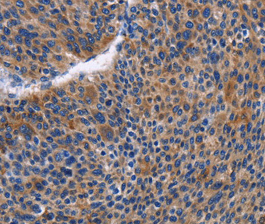 Immunohistochemistry of paraffin-embedded Human liver cancer tissue using IGSF10 Polyclonal Antibody at dilution 1:50