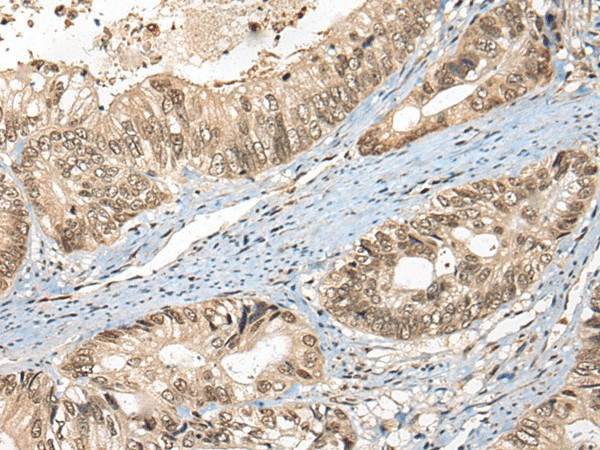 Immunohistochemistry of paraffin-embedded Human colorectal cancer tissue  using FUT4 Polyclonal Antibody at dilution of 1:40(?200)