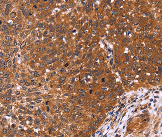 Immunohistochemistry of paraffin-embedded Human cervical cancer tissue using CDC37L1 Polyclonal Antibody at dilution 1:60