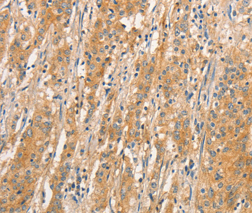 Immunohistochemistry of paraffin-embedded Human gastric cancer tissue using TLR3 Polyclonal Antibody at dilution 1:50