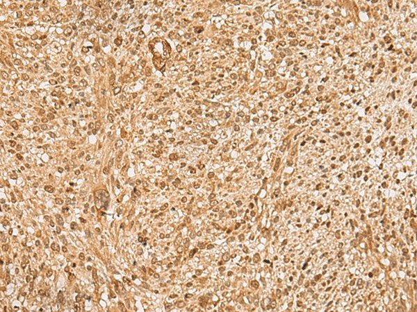 Immunohistochemistry of paraffin-embedded Human liver cancer tissue  using HIRIP3 Polyclonal Antibody at dilution of 1:60(?200)