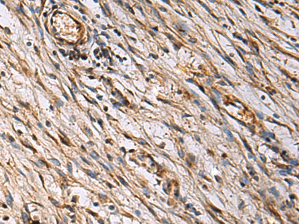 Immunohistochemistry of paraffin-embedded Human colorectal cancer tissue  using ECM1 Polyclonal Antibody at dilution of 1:25(?200)