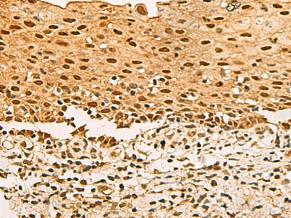 Immunohistochemistry of paraffin-embedded Human cervical cancer tissue  using UBLCP1 Polyclonal Antibody at dilution of 1:80(?200)