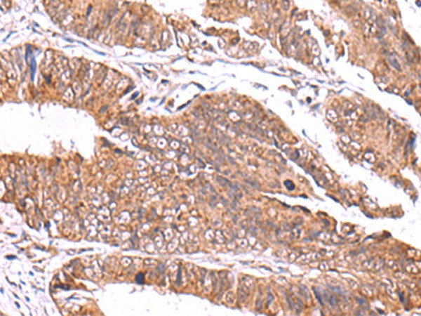 Immunohistochemistry of paraffin-embedded Human colorectal cancer tissue  using GATM Polyclonal Antibody at dilution of 1:70(?200)