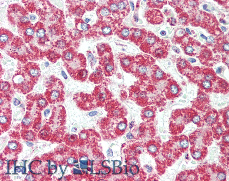 Immunohistochemistry of paraffin-embedded Human liver cancer using HSD17B8 Polyclonal Antibody at dilution of 1:100(Elabscience Product Detected by Lifespan).