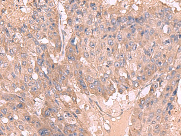 Immunohistochemistry of paraffin-embedded Human liver cancer tissue  using MAGEC2 Polyclonal Antibody at dilution of 1:50(?200)