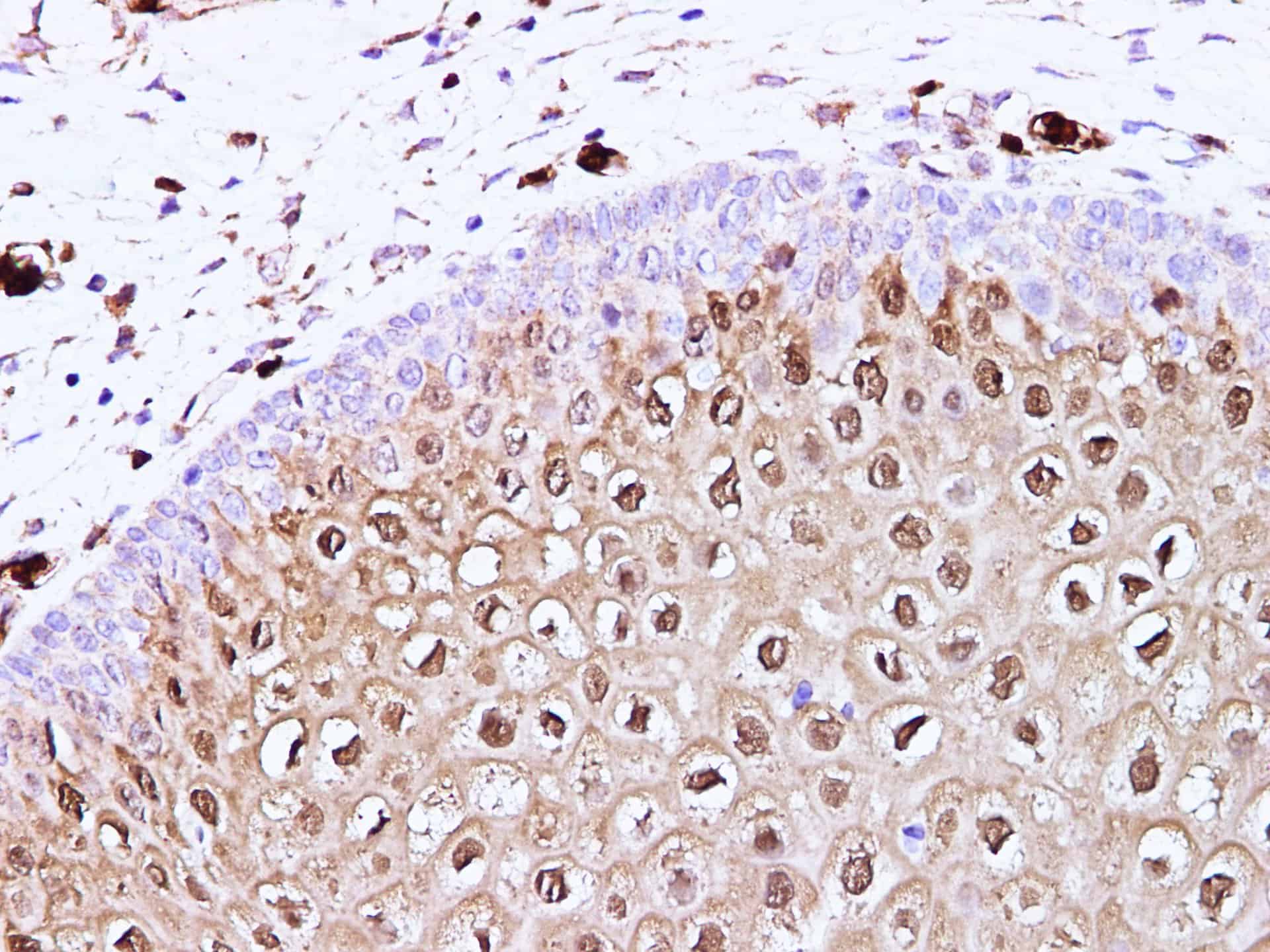 Immunohistochemistry of paraffin-embedded Human cervix using S100A8 Polyclonal Antibody at dilution of 1:100(400x)