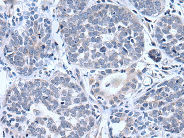 Immunohistochemistry of paraffin-embedded Human esophagus cancer tissue  using BTG4 Polyclonal Antibody at dilution of 1:55(?200)