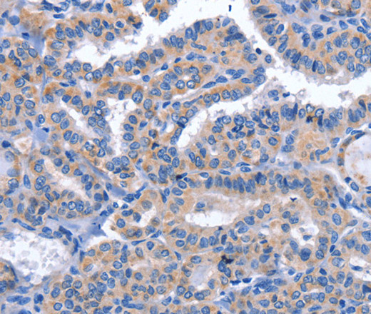 Immunohistochemistry of paraffin-embedded Human thyroid cancer tissue using CCR6 Polyclonal Antibody at dilution 1:50