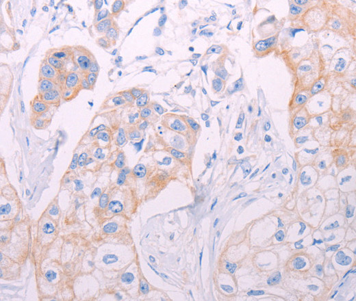 Immunohistochemistry of paraffin-embedded Human breast cancer tissue using ADAMTS14 Polyclonal Antibody at dilution 1:50