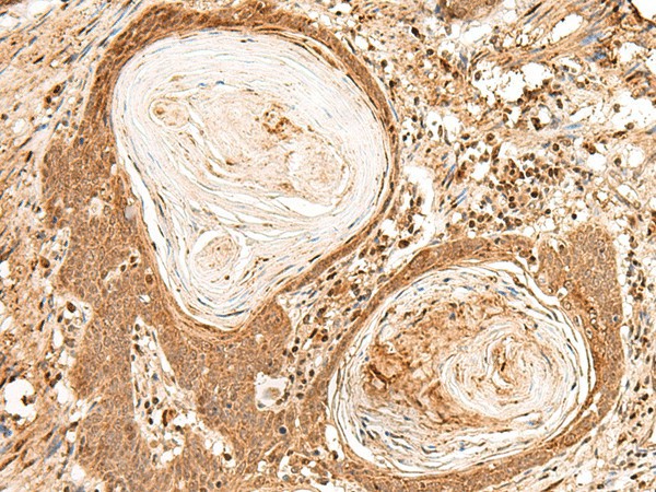 Immunohistochemistry of paraffin-embedded Human esophagus cancer tissue  using FIZ1 Polyclonal Antibody at dilution of 1:35(?200)