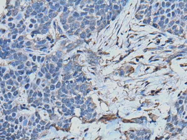 Immunohistochemistry of paraffin-embedded Human thyroid cancer tissue  using TPT1 Polyclonal Antibody at dilution of 1:45(?200)