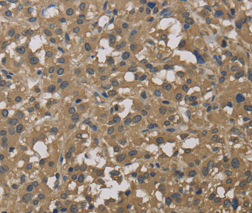 Immunohistochemistry of paraffin-embedded Human thyroid cancer tissue using DCTN3 Polyclonal Antibody at dilution 1:50