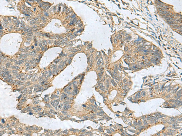 Immunohistochemistry of paraffin-embedded Human colorectal cancer tissue  using CXCR5 Polyclonal Antibody at dilution of 1:80(?200)