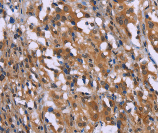 Immunohistochemistry of paraffin-embedded Human thyroid cancer using GAD1 Polyclonal Antibody at dilution of 1:40