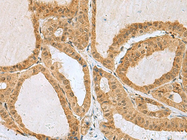 Immunohistochemistry of paraffin-embedded Human thyroid cancer tissue  using EXOSC4 Polyclonal Antibody at dilution of 1:50(?200)