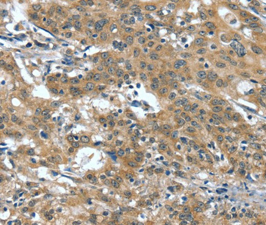 Immunohistochemistry of paraffin-embedded Human gastric cancer tissue using DTX1 Polyclonal Antibody at dilution 1:40