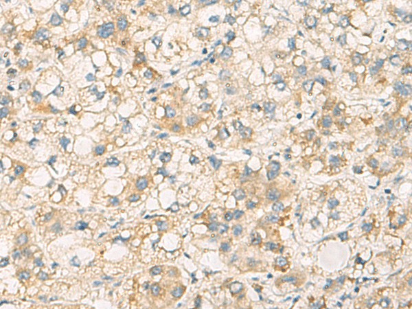 Immunohistochemistry of paraffin-embedded Human liver cancer tissue  using PAFAH1B3 Polyclonal Antibody at dilution of 1:70(?200)