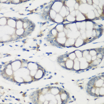 Immunohistochemistry of paraffin-embedded human colon using TNNC2 Polyclonal Antibody at dilution of 1:200 (40x lens).Perform microwave antigen retrieval with 10 mM PBS buffer pH 7.2 before commencing with IHC staining protocol.