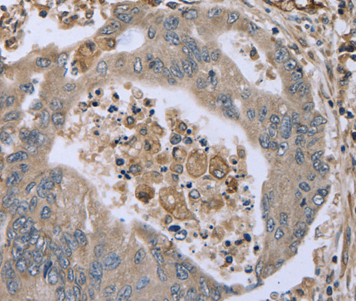 Immunohistochemistry of paraffin-embedded Human colon cancer tissue using FAP Polyclonal Antibody at dilution 1:30