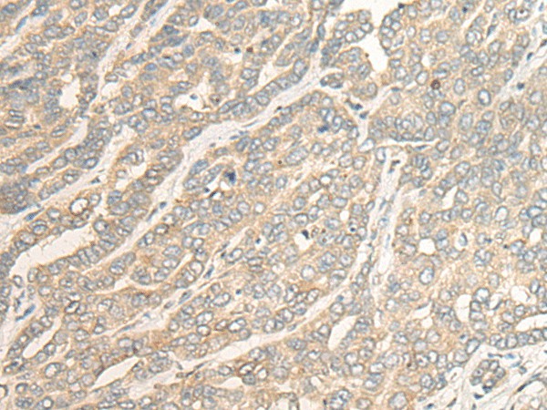 Immunohistochemistry of paraffin-embedded Human liver cancer tissue  using RSU1 Polyclonal Antibody at dilution of 1:30(?200)