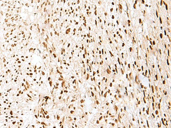 Immunohistochemistry of paraffin-embedded Human liver cancer tissue  using PRPF3 Polyclonal Antibody at dilution of 1:35(?200)