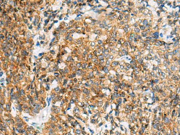 Immunohistochemistry of paraffin-embedded Human cervical cancer tissue  using TUFT1 Polyclonal Antibody at dilution of 1:120(?200)