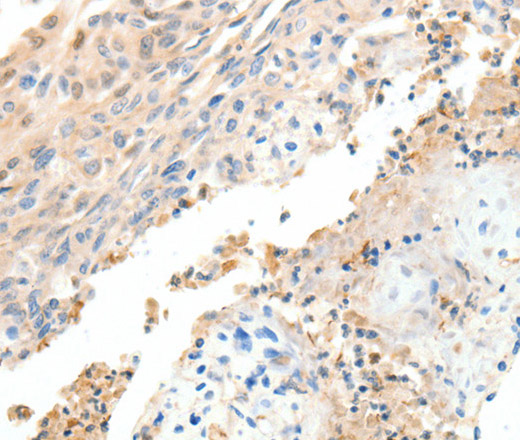 Immunohistochemistry of paraffin-embedded Human cervical cancer tissue using CXCL12 Polyclonal Antibody at dilution 1:40