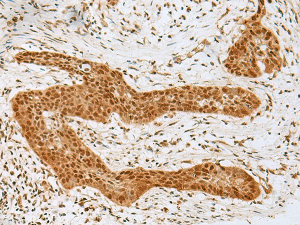 Immunohistochemistry of paraffin-embedded Human esophagus cancer tissue  using GOLGA7 Polyclonal Antibody at dilution of 1:40(?200)