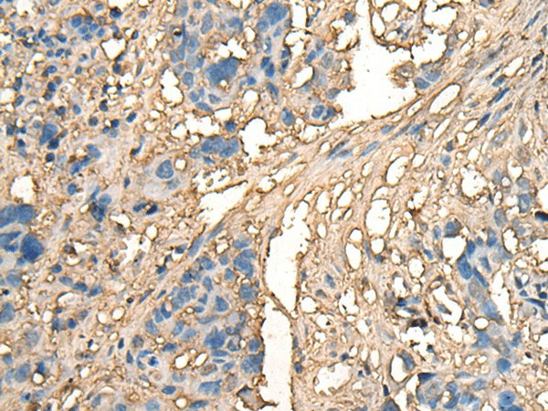 Immunohistochemistry of paraffin-embedded Human lung cancer tissue  using CELA1 Polyclonal Antibody at dilution of 1:70(?200)