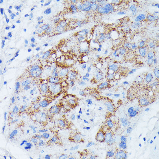 Immunohistochemistry of paraffin-embedded Human liver cancer using MANBA Polyclonal Antibody at dilution of 1:100 (40x lens).