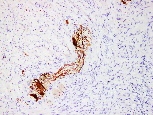 Immunohistochemistry of paraffinembedded Human peripheral ganglion of colon tissue with Neurofilament(NF) Monoclonal Antibody(Antigen repaired by EDTA).