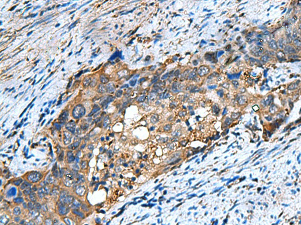 Immunohistochemistry of paraffin-embedded Human cervical cancer tissue  using COMMD9 Polyclonal Antibody at dilution of 1:60(?200)