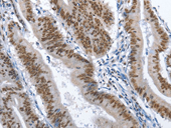 Immunohistochemistry of paraffin-embedded Human colon cancer tissue  using GNRH1 Polyclonal Antibody at dilution of 1:70(?200)