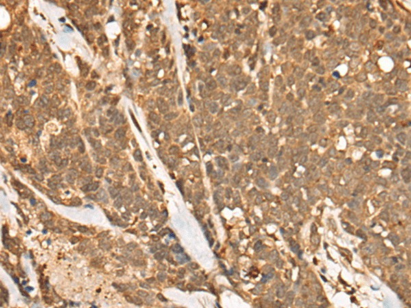 Immunohistochemistry of paraffin-embedded Human thyroid cancer tissue  using CAPN15 Polyclonal Antibody at dilution of 1:50(?200)