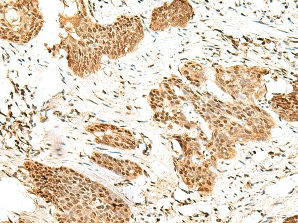 Immunohistochemistry of paraffin-embedded Human esophagus cancer tissue  using RBM19 Polyclonal Antibody at dilution of 1:45(?200)