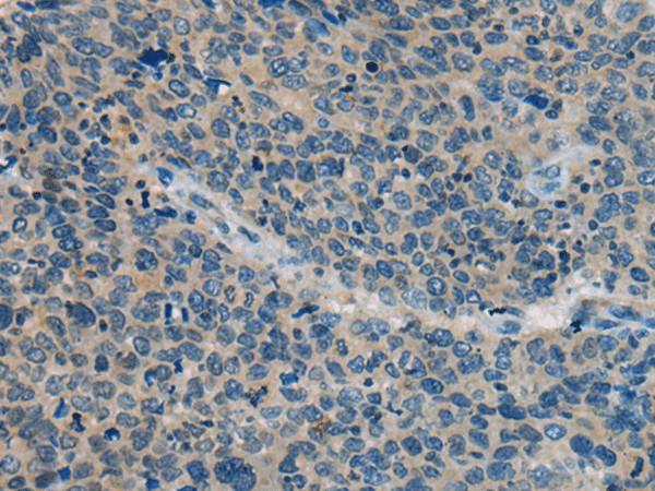 Immunohistochemistry of paraffin-embedded Human cervical cancer tissue  using BACE2 Polyclonal Antibody at dilution of 1:45(?200)