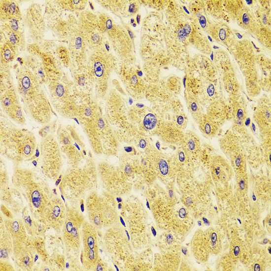 Immunohistochemistry of paraffin-embedded Human liver damage using TXNL1 Polyclonal Antibody at dilution of 1:100 (40x lens).